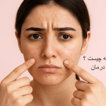 کمدون بسته چیست | راه حل و درمان